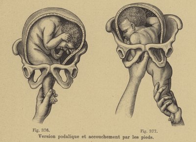Delivering a Baby Feet First (Breech Birth) by German School