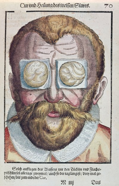 Treating an Eye Condition, from Ophthalmodouleia by Georg Bartisch, published in Dresden in 1583 by German School
