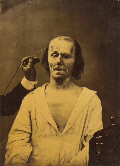 A Relaxed Face (Left); Profound Attention (Right), 1854-1856, Printed 1862 by Guillaume-Benjamin-Armand Duchenne de Boulogne