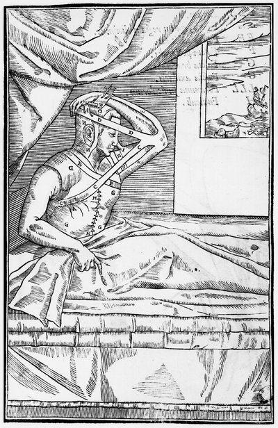 Reconstructive surgery on the nose, illustration from De curtorum chirurgia per insitionem by Gaspare Tagliacozzi, Venice, published 1597 by Italian School