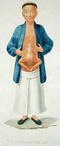 Chinese man with an undeveloped conjoined twin attached to his abdomen, illustration from a French travel book, engraved by M. Legrand by Jean Gabriel (after) Pretre