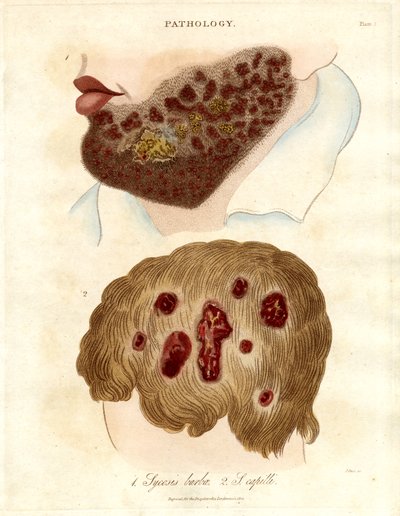 Pathological Illustration of Sycosis barbae and Sycosis capilli by John Pass
