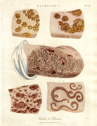 Pathological Skin Changes: Varieties of Psoriasis by John Pass