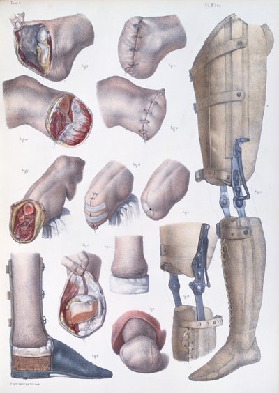 Amputations and Prosthetics, plate from 