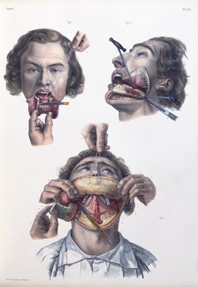 Operation on the lower jaw, plate from 