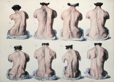 Spinal Deformities, Plate from 