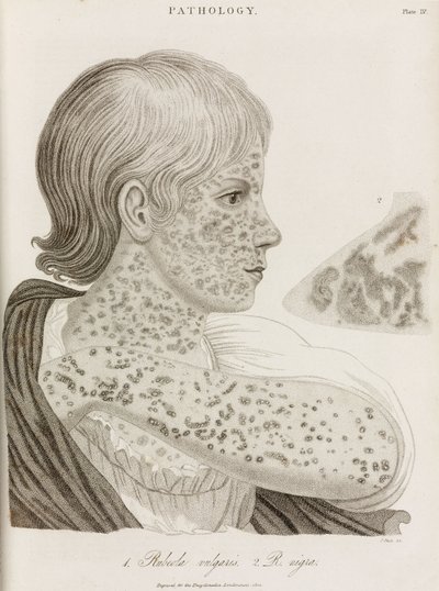 Two Types of Measles by John Pardon