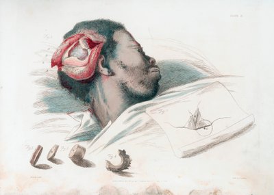 View of Wound in Skull after Trephination and Removal of Shattered Bone Piece at Bottom Left by Thomas Landseer
