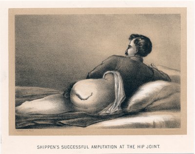 Shippens Successful Amputation at the Hip Joint, American Civil War, 1865 by Unbekannt