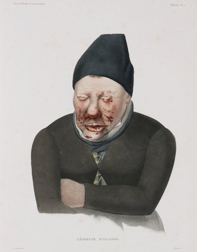Diseases, Leprosy by Unbekannt