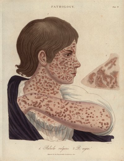 Measles and Rubeole (Lithography by John Pass, published in 