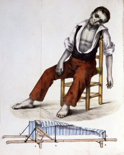 Patient with Cholera by Unbekannter Künstler