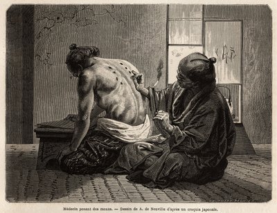 A doctor posing moxas (small sagebrush cones burned in specific parts of the body), a preventive treatment against various symptoms from indigestion to lack of appetite, crying and toothache, employed twice a year and has fixed time by the Japanese. Engrav by Unknown artist