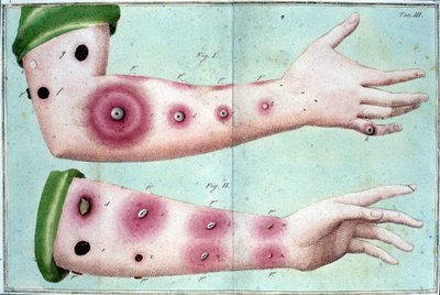 Symptoms of smallpox disease causing an outbreak of pustules on the skin. Medical plate from the “Vaccination Treat” by Luigi Sacco, Milan by Unknown artist