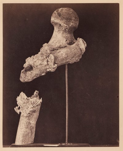 Lieutenant Goodwin, Deceased, Ununited Gunshot Fracture of the Upper Third of the Right Femur, Seven Months after the Injury, From the Photographic Catalogue of the Surgical Section by William Bell
