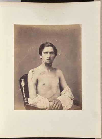 Successful Excision of the Head of the Right Humerus by William H. Bell