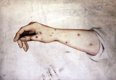 Study of a Forearm with skin condition, c.1850 by William Lover