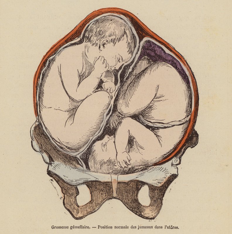 Normal Position of Twins in the Womb During Pregnancy by (after) French School