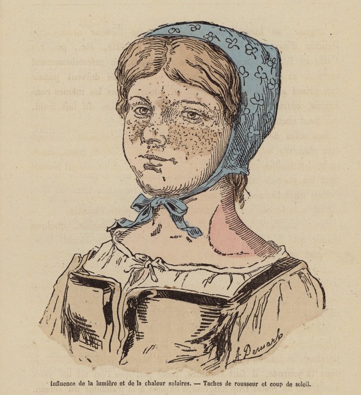 Woman with freckles and sunburn caused by excessive exposure to the Sun by (after) French School