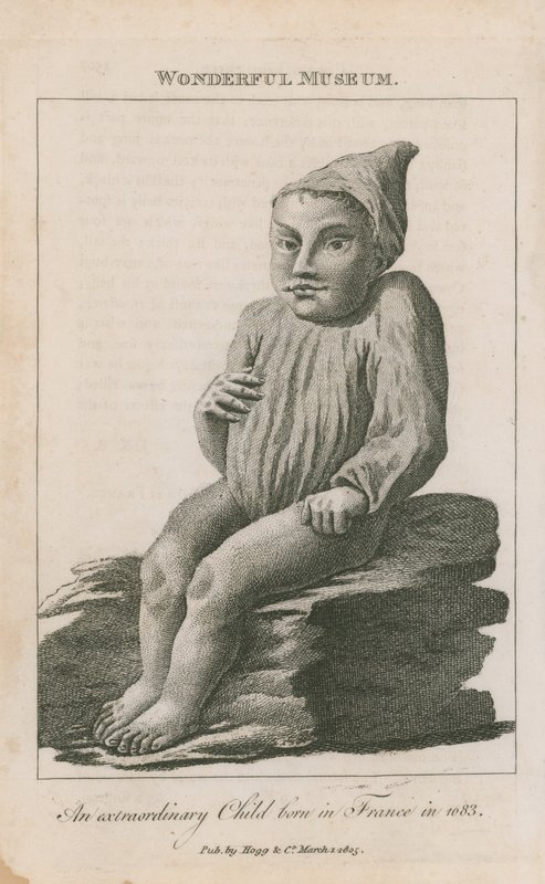 An Extraordinary Child Born in France in 1683 by English School