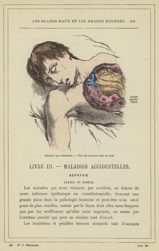 Asphyxia by Submersion, State of the Lungs in a Drowned Person by French School