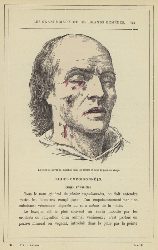 Hatching of Fly Larvae in Cavities and Under the Skin of the Face by French School