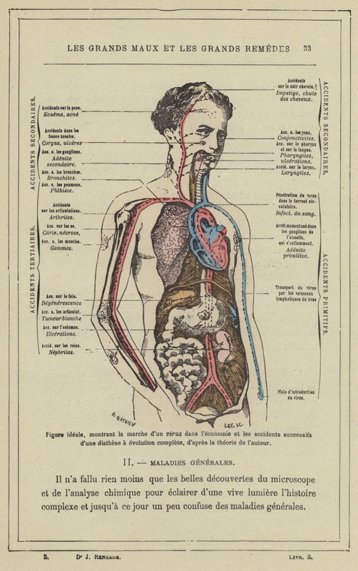 Ideal figure, showing the progression of a virus in the body and the successive accidents of a diathesis with complete evolution, according to the author