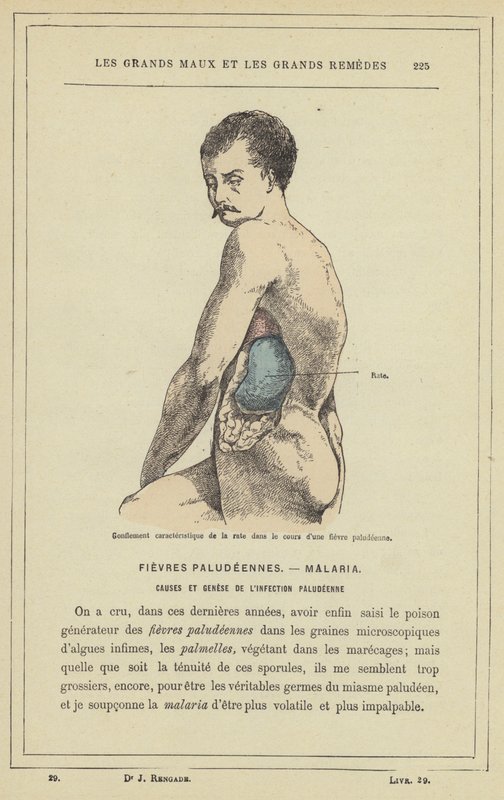 Characteristic Swelling of the Spleen During a Malarial Fever by French School