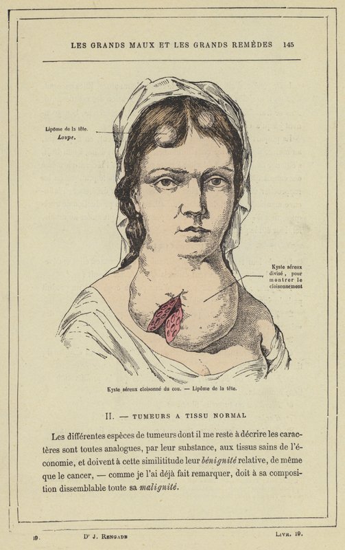 Partitioned Serous Cyst of the Neck, Head Lipoma by French School