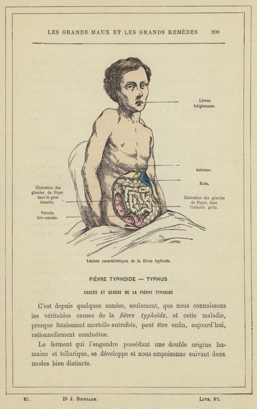 Characteristic Lesions of Typhoid Fever by French School