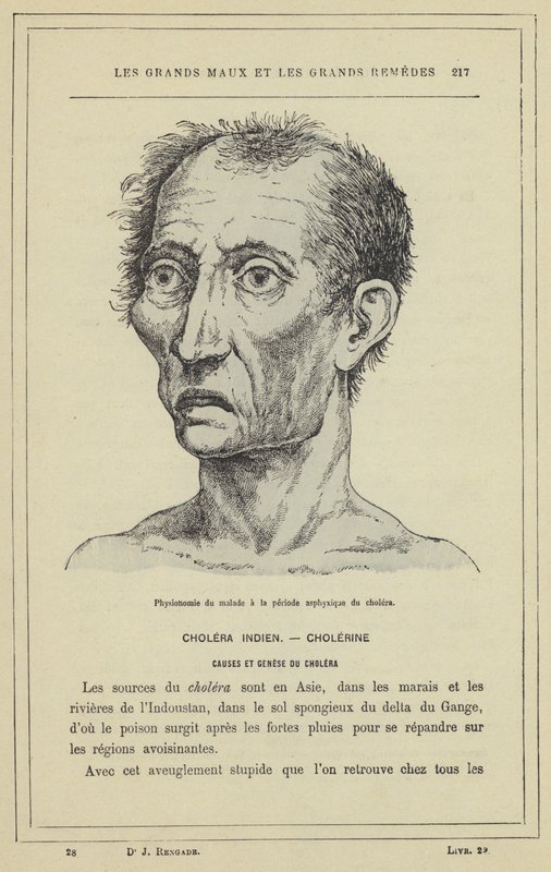 Appearance of the Patient in the Asphyxial Stage of Cholera by French School