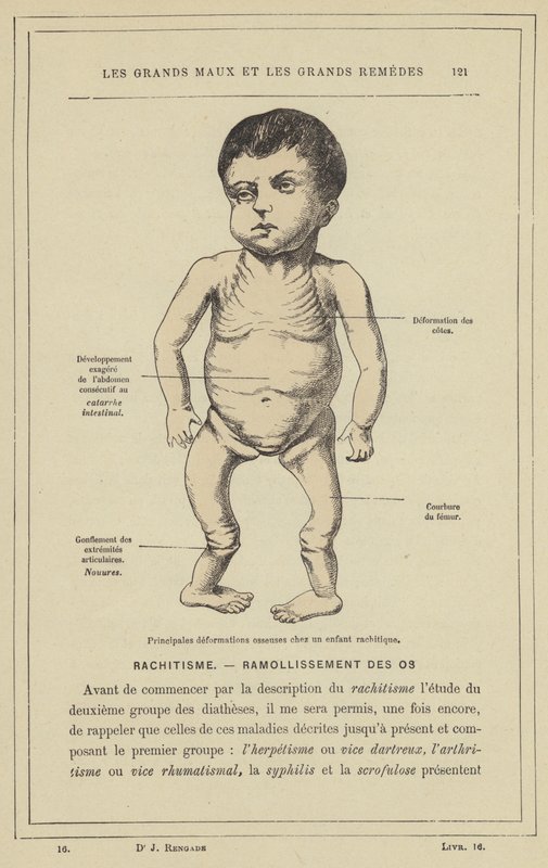 Main Bone Deformations in a Rachitic Child by French School