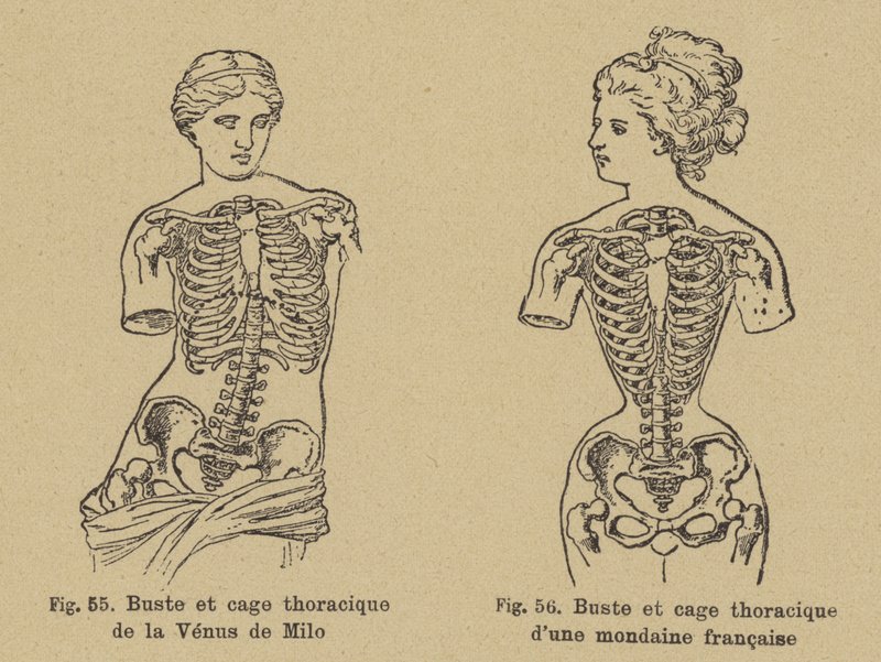 Comparison of the shape of the chest and ribcage of the Venus de Milo with that of a late 19th Century French socialite by German School