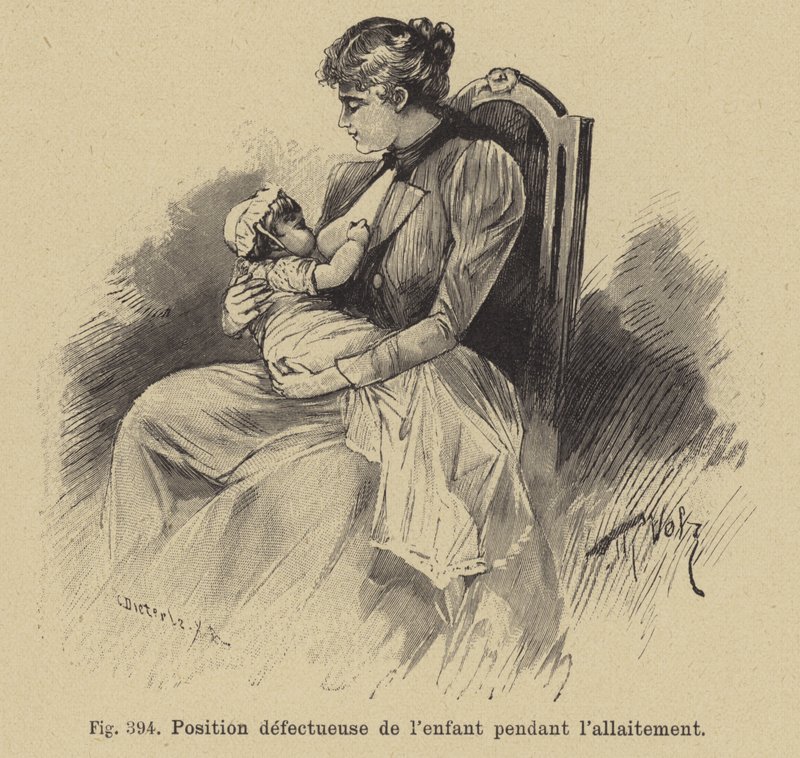 Incorrect Position of a Baby During Breastfeeding by German School