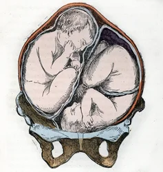 Representation of the good position of two fetuses during a twin pregnancy, engraving from «La nature et l