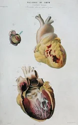 Plate depicting heart diseases. Spontaneous rupture of the heart of an 86 year old woman and pericarditis in a six day old baby, from 