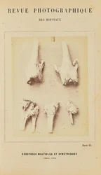 Multiple and Symmetrical Exostoses, Femur, Tibia