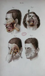 Anatomical plate of the upper jaw