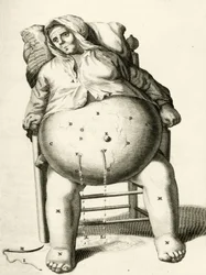Draining fluids from an abscess, from Exercitationes Practicae circa Medendi Methodum by Frederik Dekkers, 1694