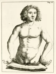 Example of congenital birth defects, from Exercitationes Practicae circa Medendi Methodum by Frederik Dekkers, 1694