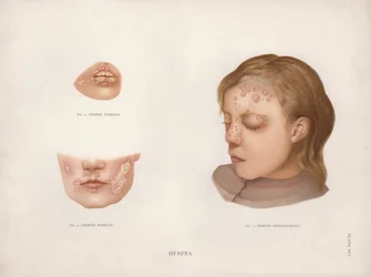 Diseases of the Skin: Herpes
