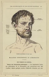 Characteristic Accidents of Acute Glanders