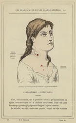 Characteristic accidents of scrofula in the secondary period