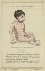 Aspect and Distribution of Measles Spots at the Beginning of the Eruption