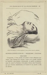 Attitude of a Hysterical Person in the Cataleptic Stage of the Attack and During the Crucifixion Phase