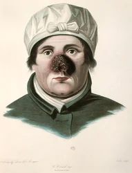 Before a skin graft operation, from 