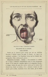 Ulcerated Cancer of the Tongue, Degeneration of the Glands