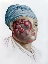 Cancerous scrofula, from Description des Maladies de la Peau by Baron Jean Louis Alibert