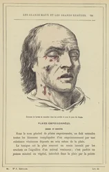 Hatching of Fly Larvae in Cavities and Under the Skin of the Face