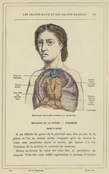 Pleural Effusion Caused by Pleurisy